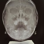 Рентген снимок придаточных пазух в норме